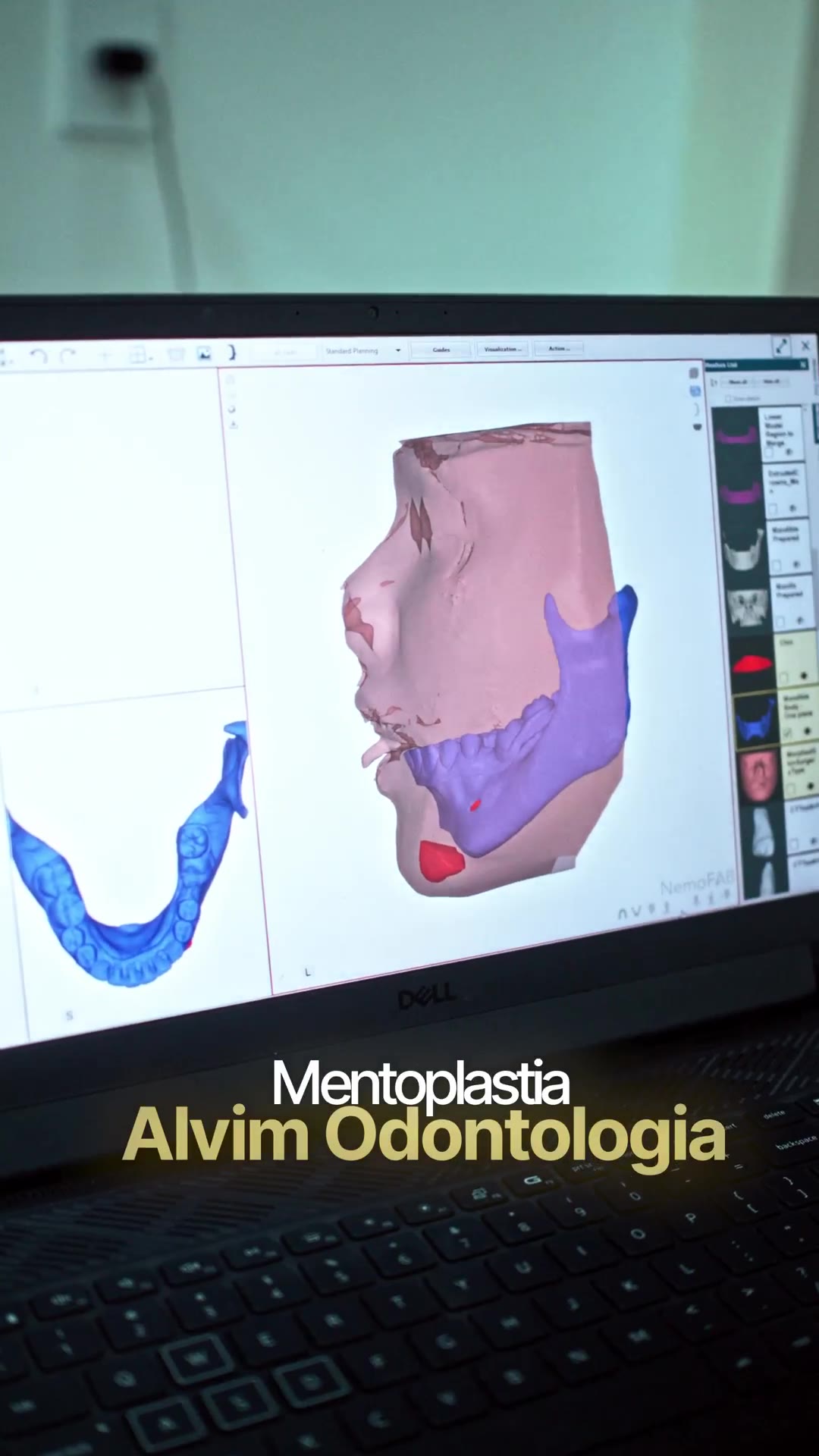 Mentoplastia, AOI